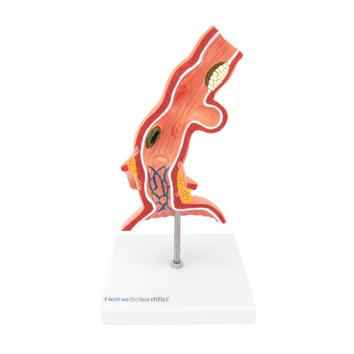 HeineScientific Oesophagus Model with Diseases