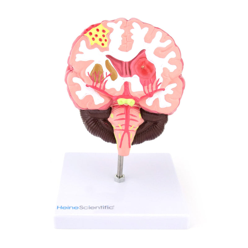 HeineScientific Brain Model with Diseases