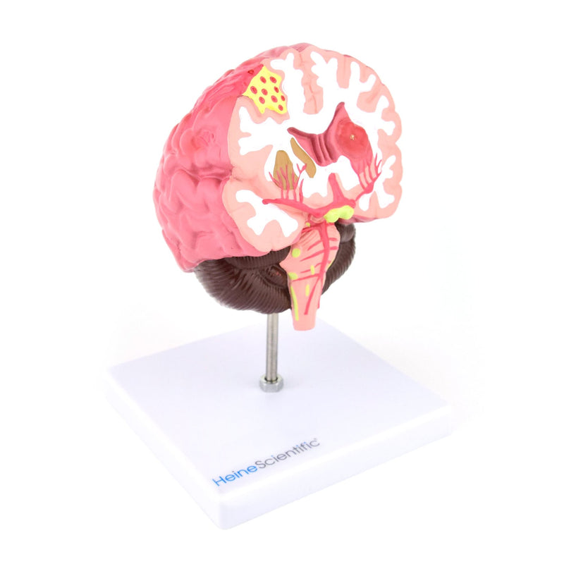 HeineScientific Brain Model with Diseases
