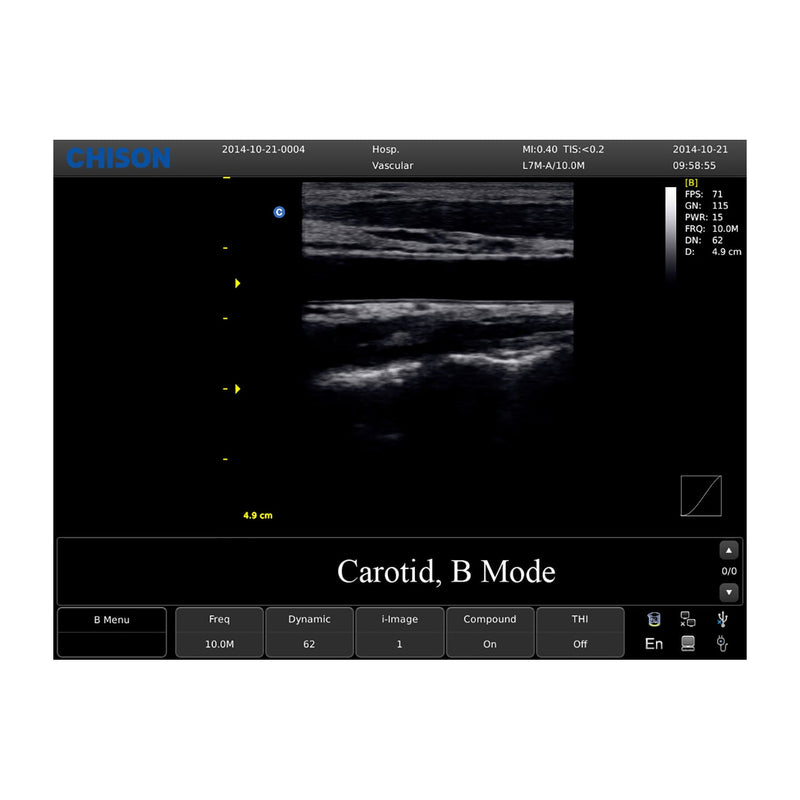 Chison ECO 1 Portable Ultrasound Machine