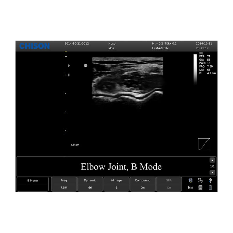 Chison ECO 1 Portable Ultrasound Machine