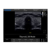 Chison ECO 1 Portable Ultrasound Machine