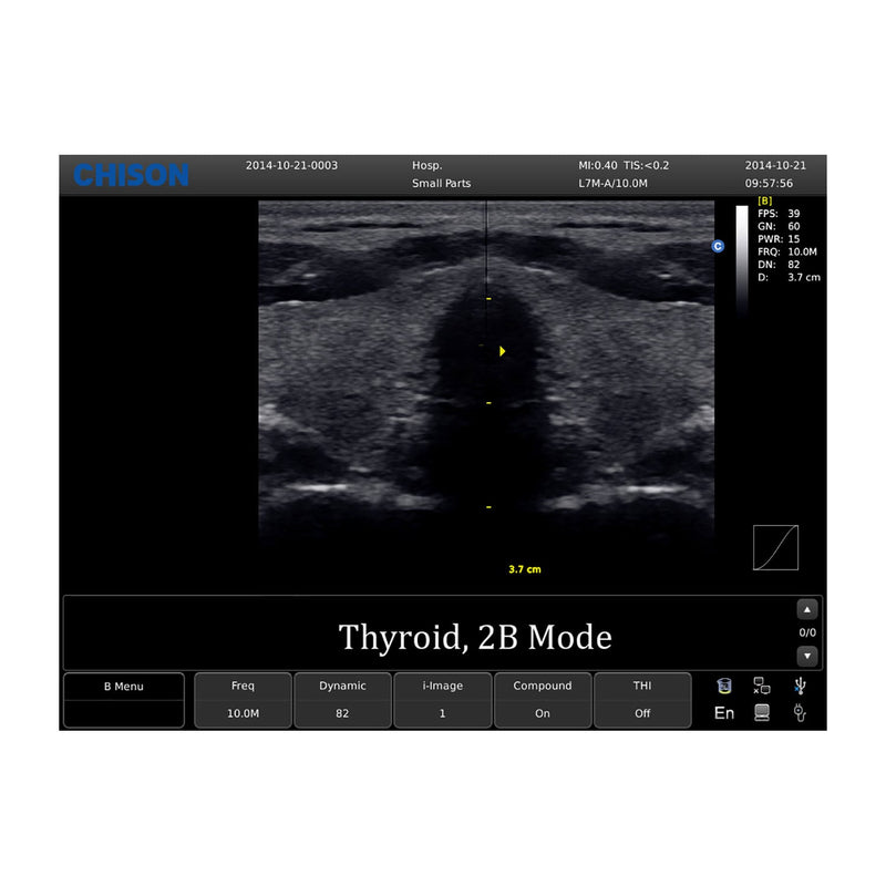 Chison ECO 1 Portable Ultrasound Machine