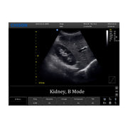Chison ECO 1 Portable Ultrasound Machine