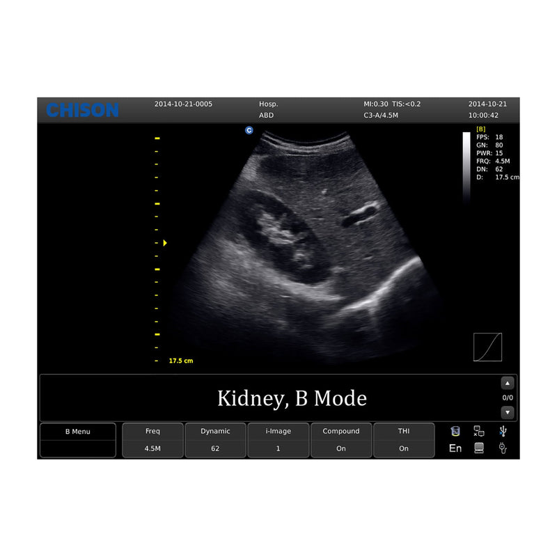 Chison ECO 1 Portable Ultrasound Machine