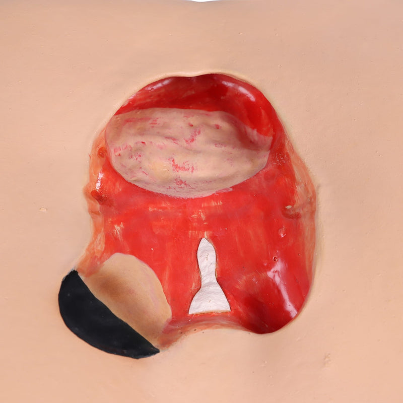 Erler-Zimmer DECUBITUS DAN Treatment Simulator