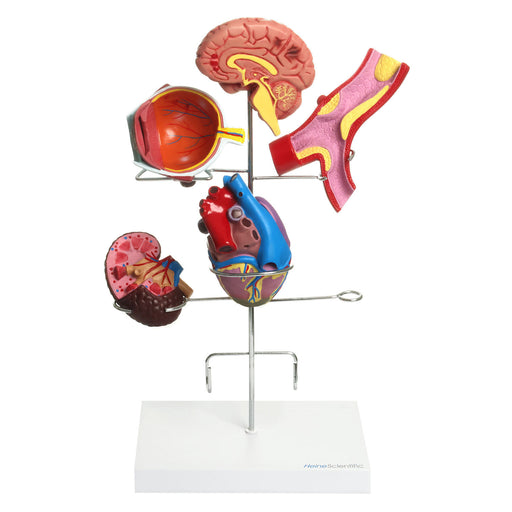 HeineScientific Hypertension Model Set 6-Part Anatomical Model