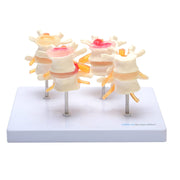 HeineScientific Intervertebral Disc Model Skeletal Educational Aid