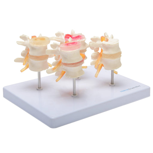 HeineScientific Intervertebral Disc Model Skeletal Educational Aid