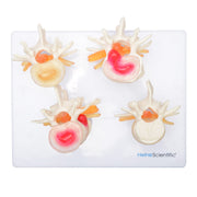 HeineScientific Intervertebral Disc Model Skeletal Educational Aid