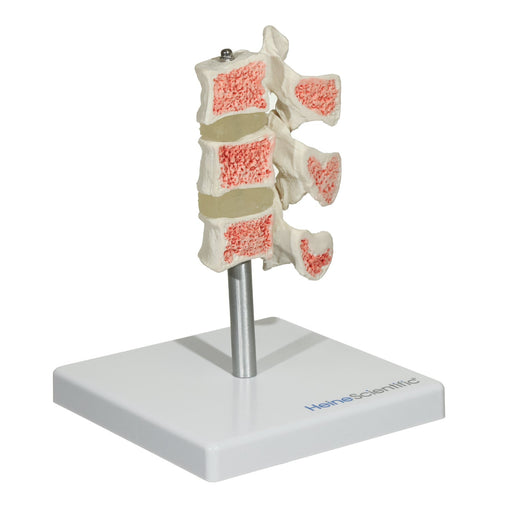 HeineScientific Osteoporosis Model Skeletal Model 3 Vertebrae