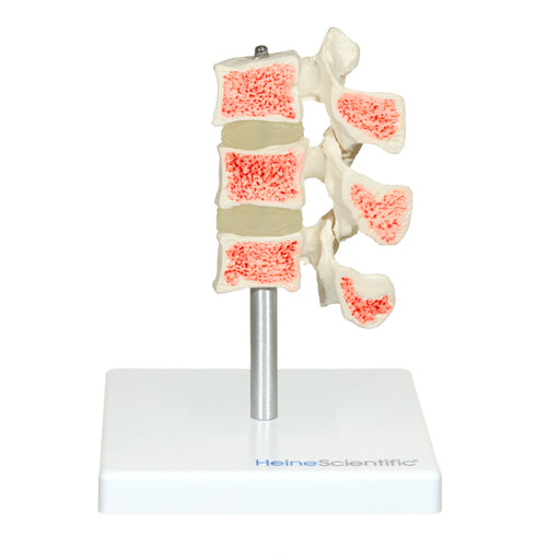 HeineScientific Osteoporosis Model Skeletal Model 3 Vertebrae