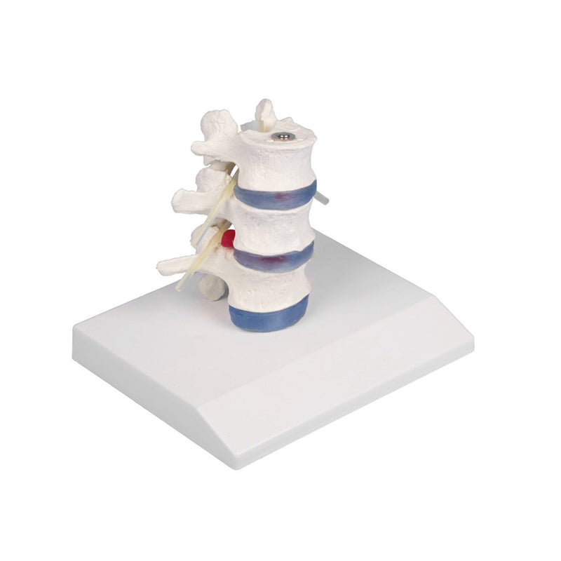 Erler-Zimmer Model Lumbar Vertebra with Herniated Disc