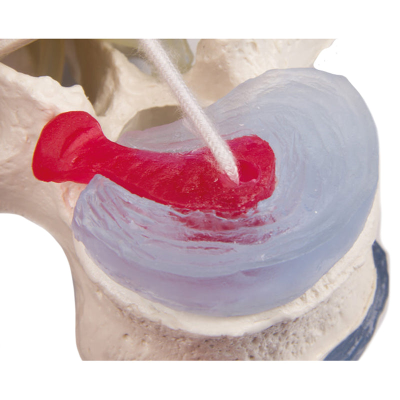 Erler-Zimmer Model Lumbar Vertebra with Herniated Disc