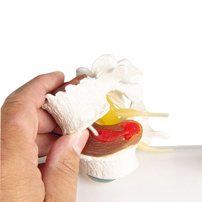 Erler-Zimmer Stages of Disc Degeneration Anatomical Model