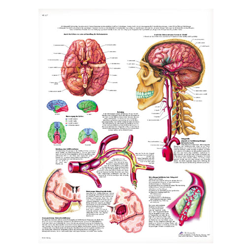3B Scientific Stroke Wall Chart Laminated