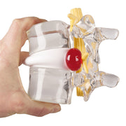 Erler-Zimmer Herniated Disc Simulator Double Life-Size