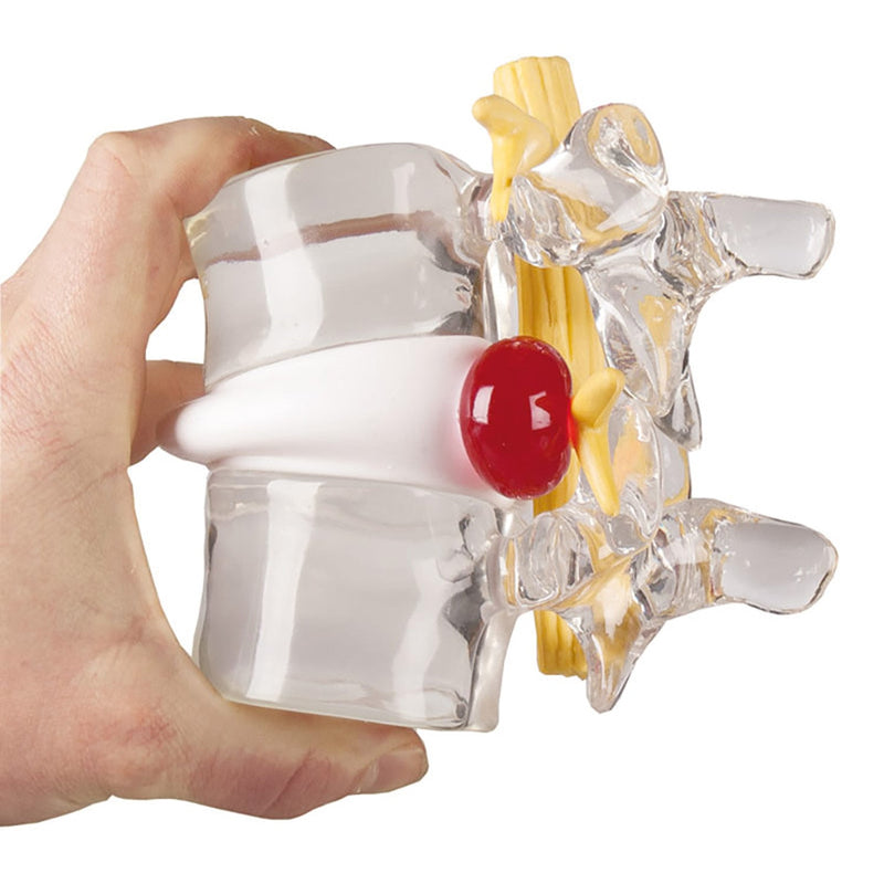 Erler-Zimmer Herniated Disc Simulator Double Life-Size