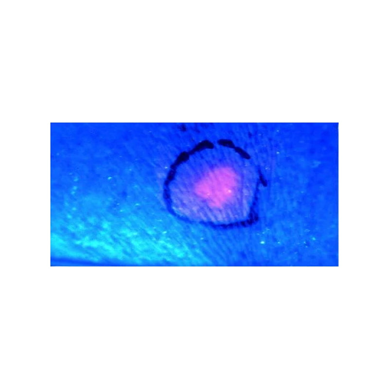 IdealDerm Wood's Lamp Diagnostic Dermatoscope