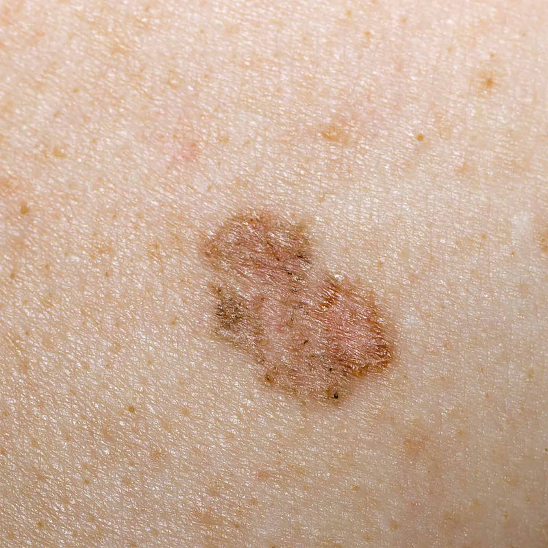 LUXAMED LuxaScope CCT Dermatoscope